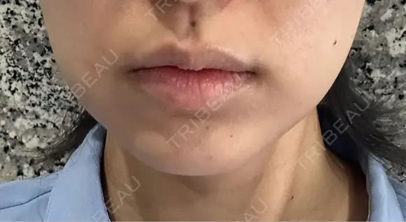 ボトックス（あご） / ボトックス（エラ・小顔） / ボトックス（口角） / ボトックス（眉間） Belle Via Skin Clinic DAY 0 メイン用