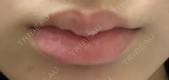 ヒアルロン酸注入（唇） 目白ホワイトクリニック DAY 9 メイン用