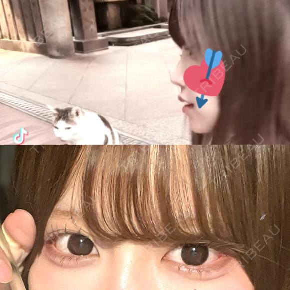ヒアルロン酸注入（涙袋） / ヒアルロン酸注入（唇） HAAB×DREAM BEAUTY CLINIC 大阪梅田院 AFTER メイン用