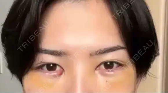 クマ治療 / その他（輪郭） WOM CLINIC GINZA （ワム クリニック ギンザ） DAY 7 メイン用