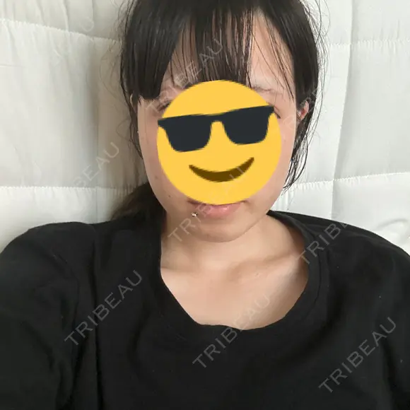 ボトックス（エラ・小顔） 東京シルククリニック 新宿院 DAY 2 メイン用