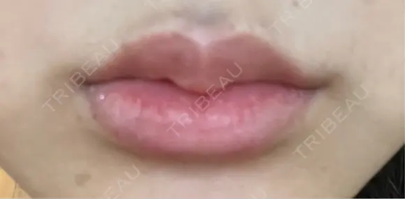 ヒアルロン酸注入（唇） 目白ホワイトクリニック DAY 10 メイン用