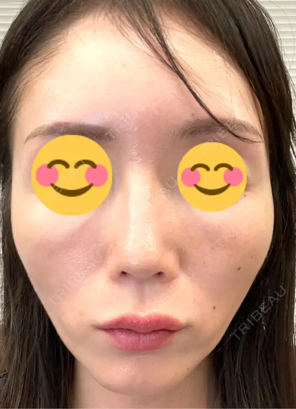 ピコレーザートーニング（美白・肝斑） シェリークリニック 渋谷院 DAY 4 メイン用