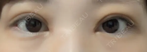 二重切開 / 目頭切開 / 眼瞼下垂（切開） EMMA CLINIC（エマクリニック） DAY 14 メイン用