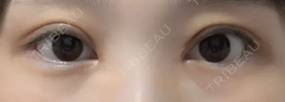 二重切開 / 目頭切開 / 眼瞼下垂（切開） EMMA CLINIC（エマクリニック） DAY 31 メイン用