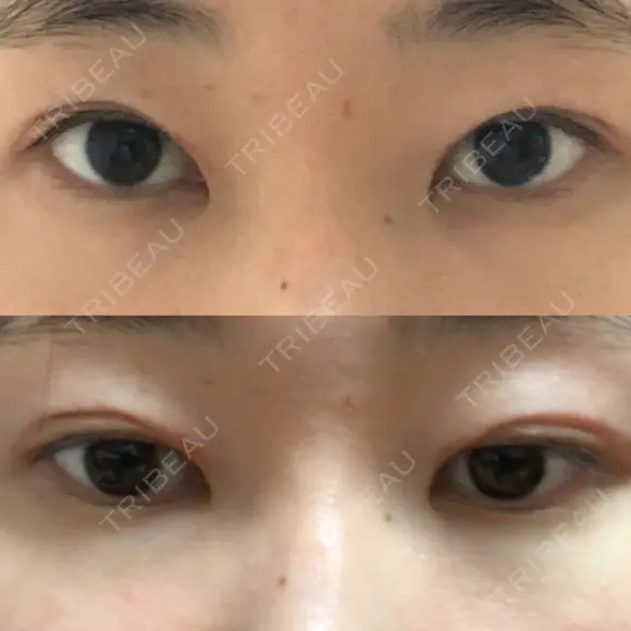 二重切開 表参道スキンクリニック 表参道院 DAY 98 メイン用