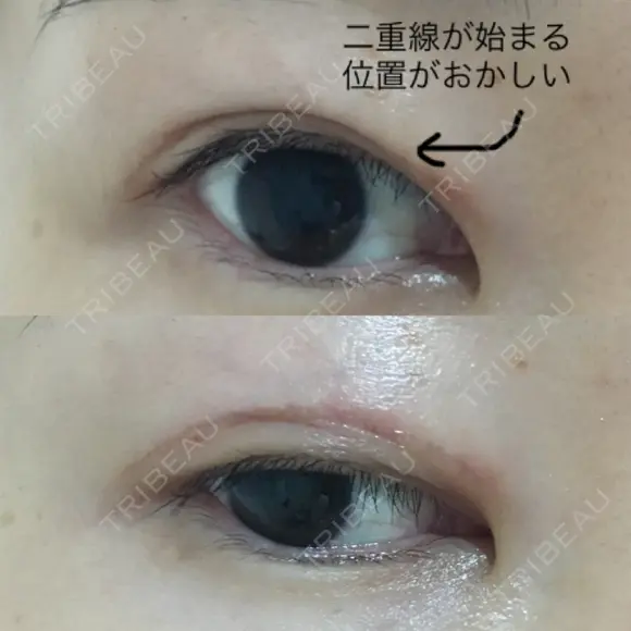 二重切開 表参道スキンクリニック 表参道院 DAY 98 メイン用