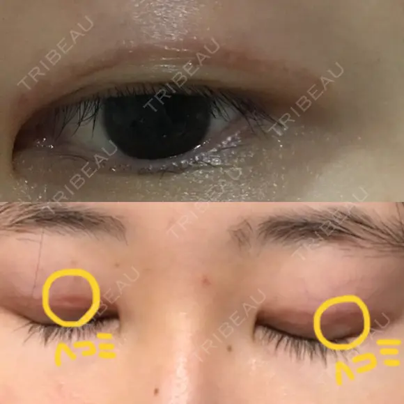 二重切開 表参道スキンクリニック 表参道院 DAY 98 メイン用