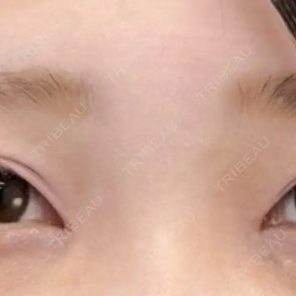 目頭切開 ネビュラクリニック 京都院 AFTER メイン用