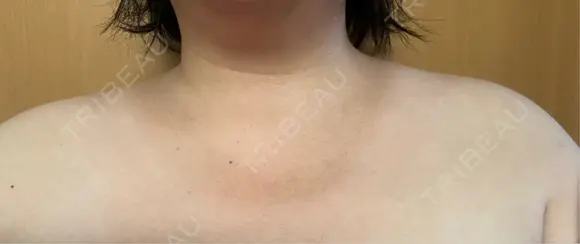 ボトックス（肩） アリエル美容クリニック 横浜院 DAY 29 メイン用