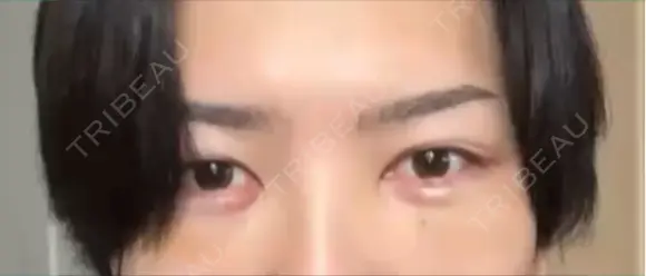 クマ治療 / その他（輪郭） WOM CLINIC GINZA （ワム クリニック ギンザ） DAY 10 メイン用