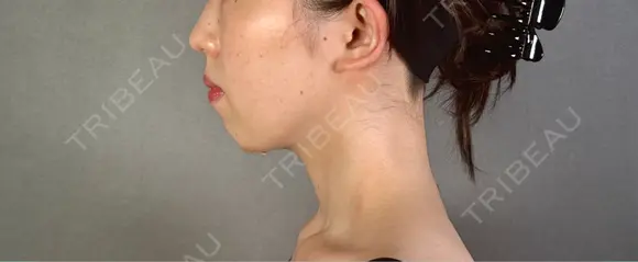 糸リフト / バッカルファット除去 / 脂肪吸引（顔） / ジョールファット除去 / ボトックス（エラ・小顔） アリエル美容クリニック 郡山院 DAY 93 メイン用