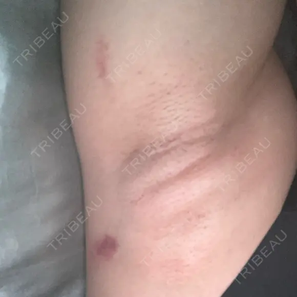 ワキ汗治療（レーザー） ゆう美容クリニック DAY 2 メイン用