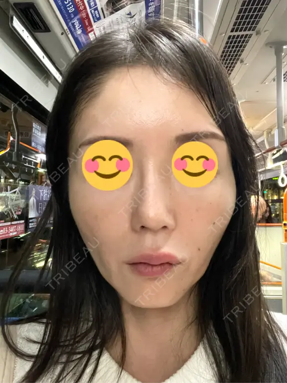 ピコレーザートーニング（美白・肝斑） シェリークリニック 渋谷院 DAY 5 メイン用