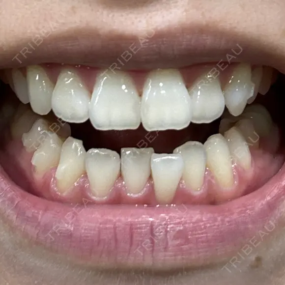 矯正（マウスピース） 湘南歯科クリニック 池袋院 DAY 54 メイン用