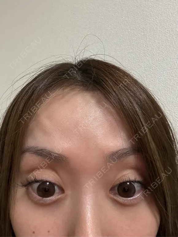 ボトックス（額） 大美会クリニック 京都烏丸院 DAY 54 メイン用