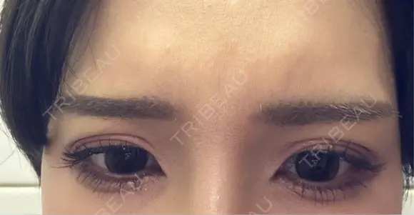 ボトックス（あご） / ボトックス（エラ・小顔） / ボトックス（口角） / ボトックス（眉間） Belle Via Skin Clinic AFTER メイン用