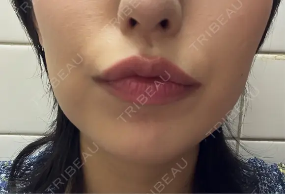 ボトックス（あご） / ボトックス（エラ・小顔） / ボトックス（口角） / ボトックス（眉間） Belle Via Skin Clinic DAY 3 メイン用