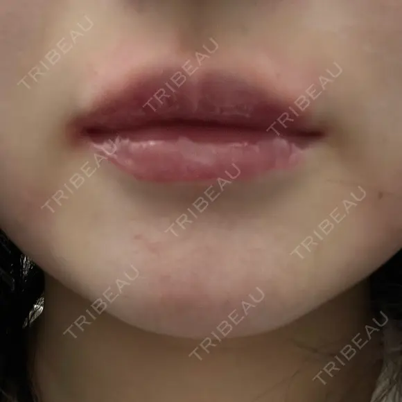 ボトックス（口角） / ボトックス（人中） DMTC CLINIC 日本橋院 DAY 0 メイン用