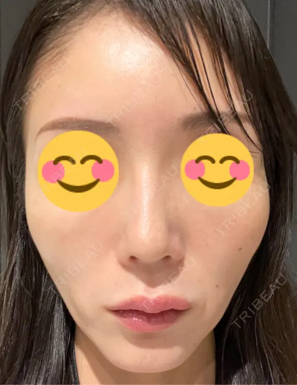 ピコレーザートーニング（美白・肝斑） シェリークリニック 渋谷院 DAY 7 メイン用