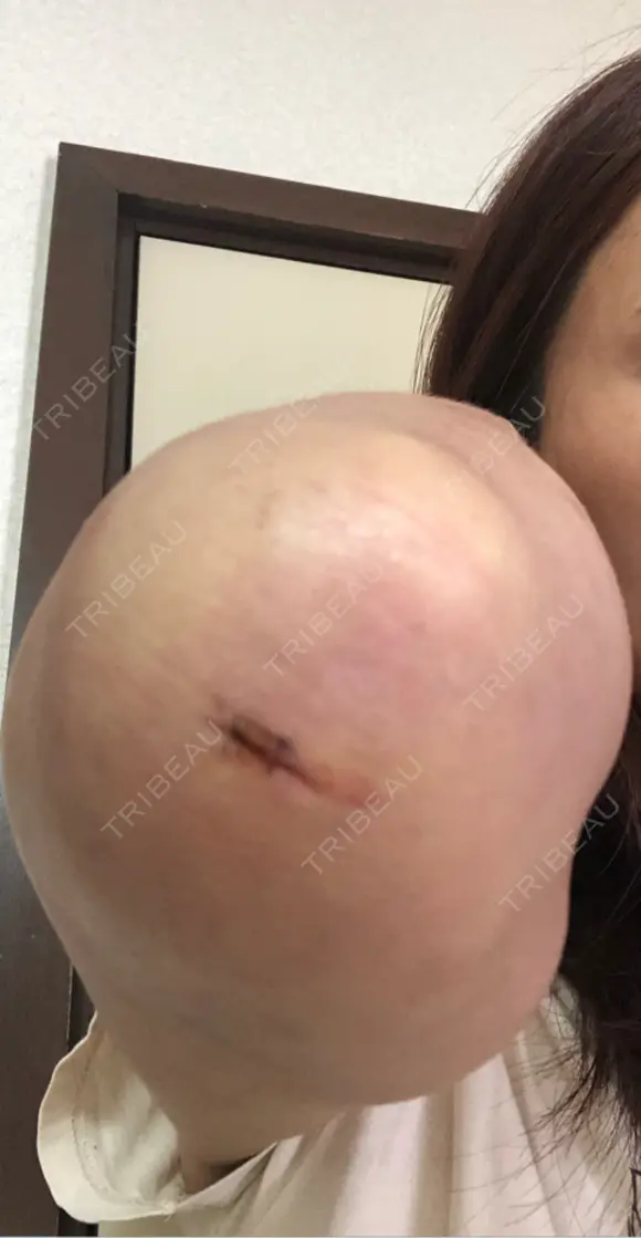 脂肪吸引（二の腕） 湘南美容クリニック 高崎院 DAY 4 メイン用