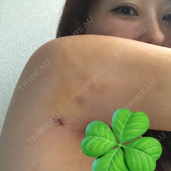 脂肪吸引（二の腕） 湘南美容クリニック 高崎院 DAY 5 メイン用