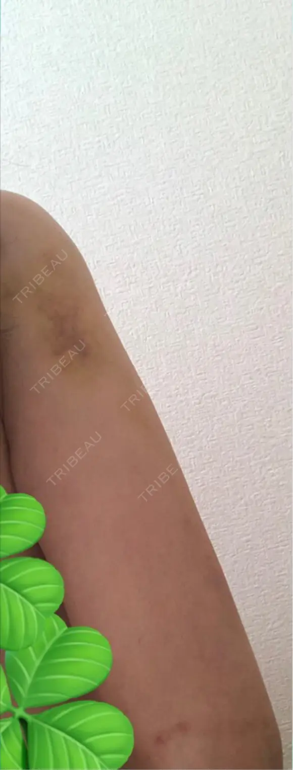 脂肪吸引（二の腕） 湘南美容クリニック 高崎院 DAY 5 メイン用