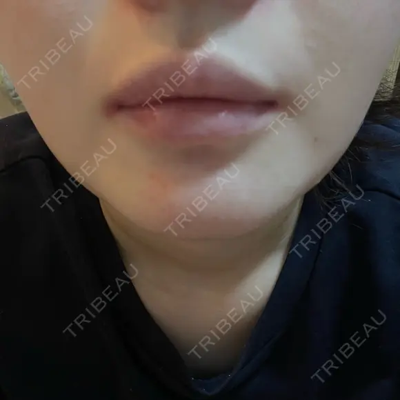 ボトックス（口角） / ボトックス（人中） DMTC CLINIC 日本橋院 DAY 1 メイン用