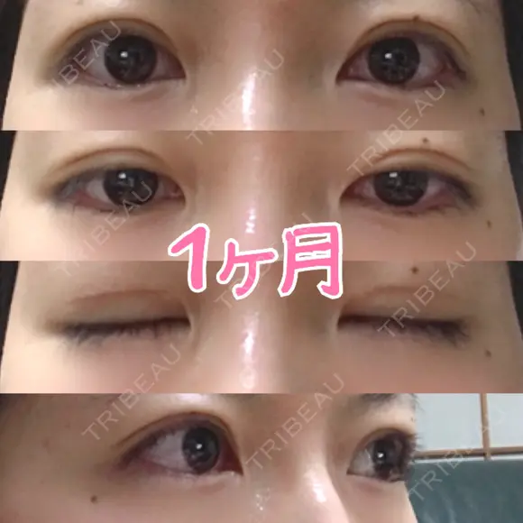 眼瞼下垂（切開） / 上まぶたの脂肪取り 白山クリニック 大分 DAY 30 メイン用