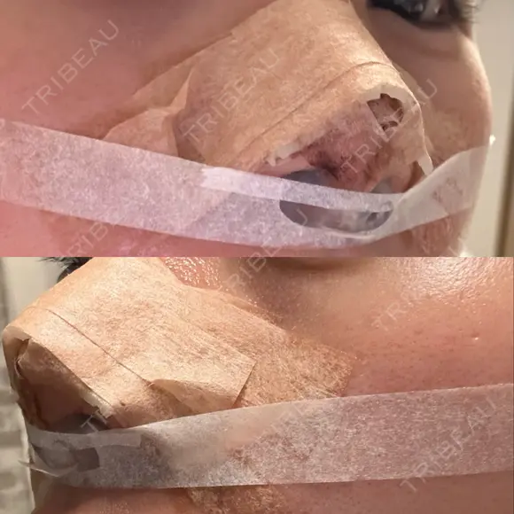 鼻尖形成（切開） / 小鼻縮小（切開） / 軟骨移植 ASTRA BEAUTY CLINIC DAY 17 メイン用