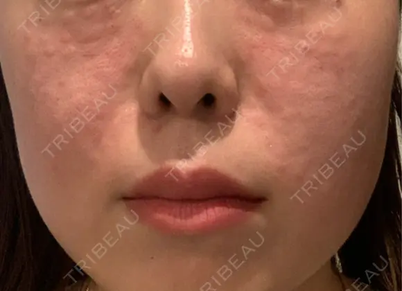 リジュラン 新宿Ladies&Gentlemen美容クリニック DAY 0 メイン用