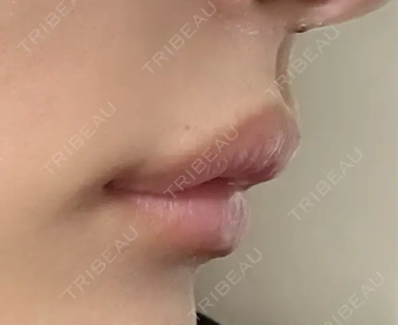 ヒアルロン酸注入（唇） / ボトックス（人中） THE FIRST CLINIC 町田院 DAY 1 メイン用