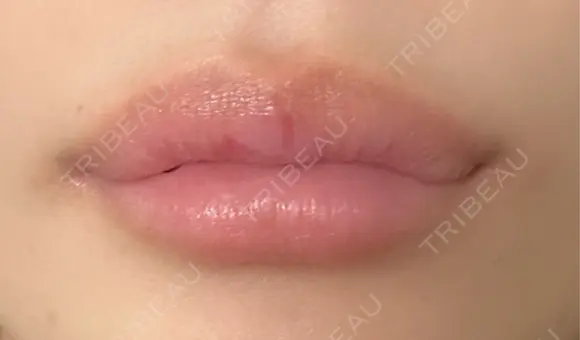 ヒアルロン酸注入（唇） / ボトックス（人中） THE FIRST CLINIC 町田院 DAY 1 メイン用