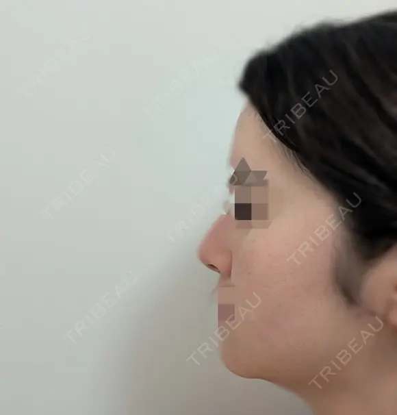 鼻尖縮小 / ヒアルロン酸注入（鼻） 東京ヒルズクリニック 銀座院 DAY 14 メイン用