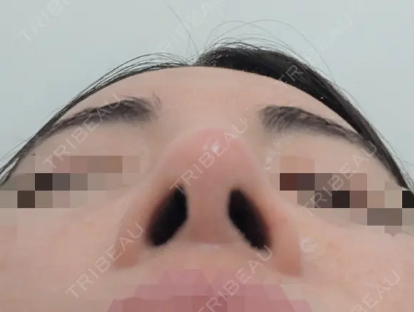 鼻尖縮小 / ヒアルロン酸注入（鼻） 東京ヒルズクリニック 銀座院 DAY 14 メイン用