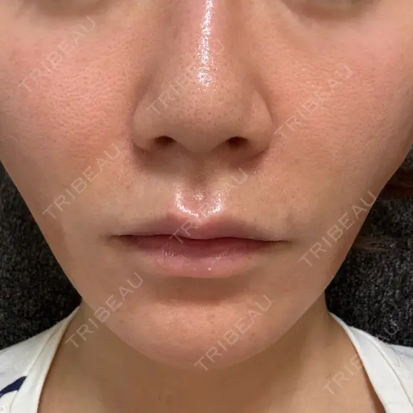 糸リフト Wing clinic 豊中駅前院 AFTER メイン用