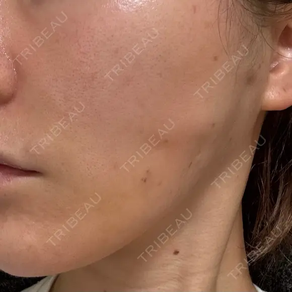 糸リフト Wing clinic 豊中駅前院 DAY 1 メイン用