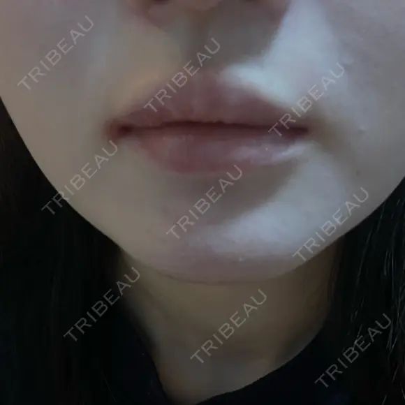 ボトックス（口角） / ボトックス（人中） DMTC CLINIC 日本橋院 DAY 2 メイン用