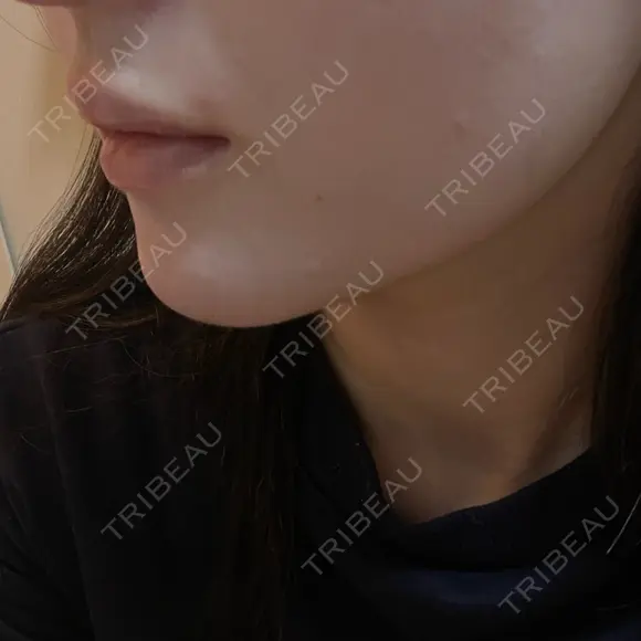 ボトックス（口角） / ボトックス（人中） DMTC CLINIC 日本橋院 DAY 2 メイン用