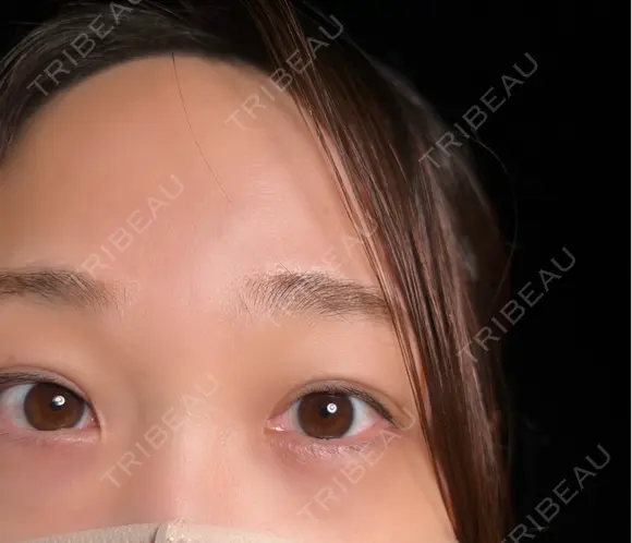 二重埋没 / 上まぶたの脂肪取り 9BeautyClinic AFTER メイン用