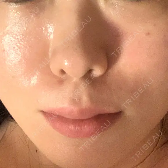 リジュラン 新宿Ladies&Gentlemen美容クリニック DAY 1 メイン用