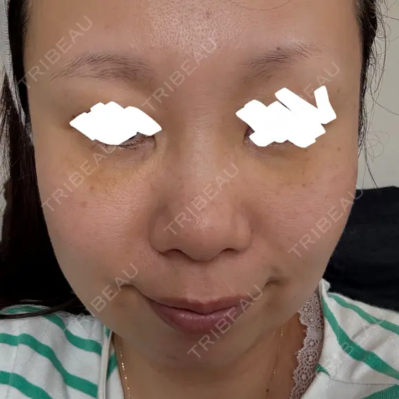 下まぶたたるみ取り アネシス美容クリニック DAY 0 メイン用