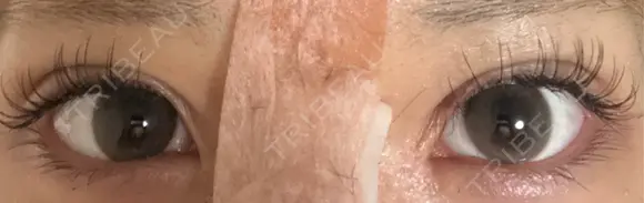 二重埋没 J CLINIC AFTER メイン用