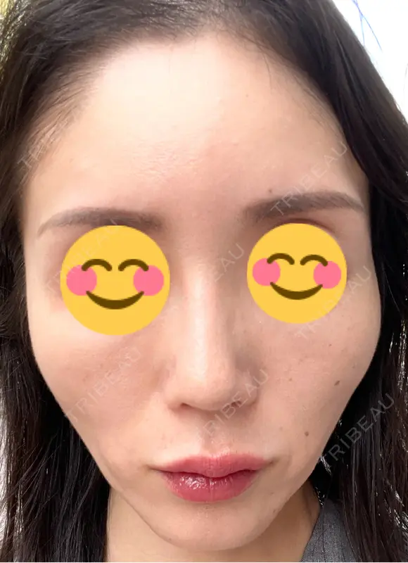 ピコレーザートーニング（美白・肝斑） シェリークリニック 渋谷院 DAY 9 メイン用