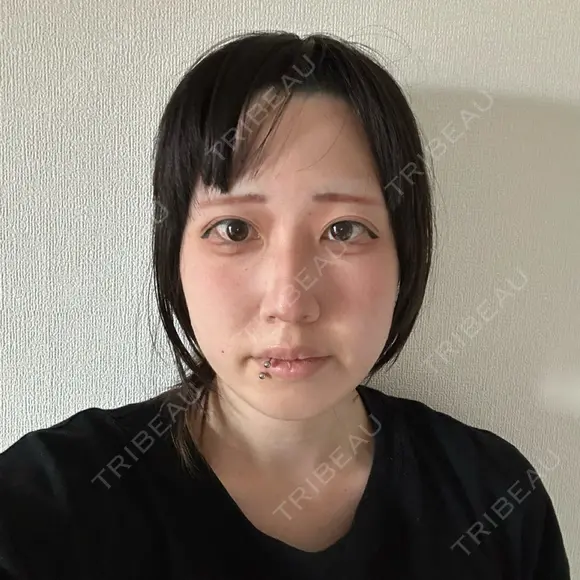 ボトックス（エラ・小顔） 東京シルククリニック 新宿院 AFTER メイン用