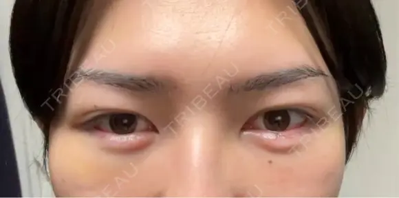 クマ治療 / その他（輪郭） WOM CLINIC GINZA （ワム クリニック ギンザ） DAY 14 メイン用