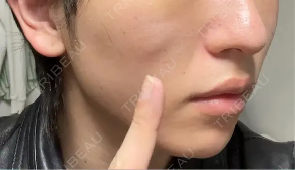 クマ治療 / その他（輪郭） WOM CLINIC GINZA （ワム クリニック ギンザ） DAY 14 メイン用