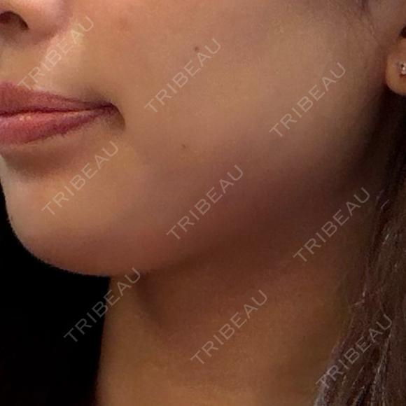 ヒアルロン酸注入（あご） フィラークリニック 名古屋栄院 AFTER メイン用