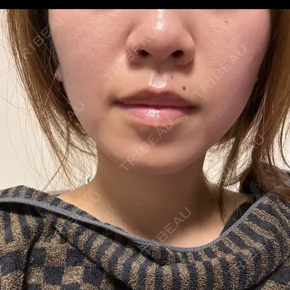 ベビーコラーゲン / RF（高周波）たるみ治療 TUNE CLINIC【チューンクリニック】 AFTER メイン用