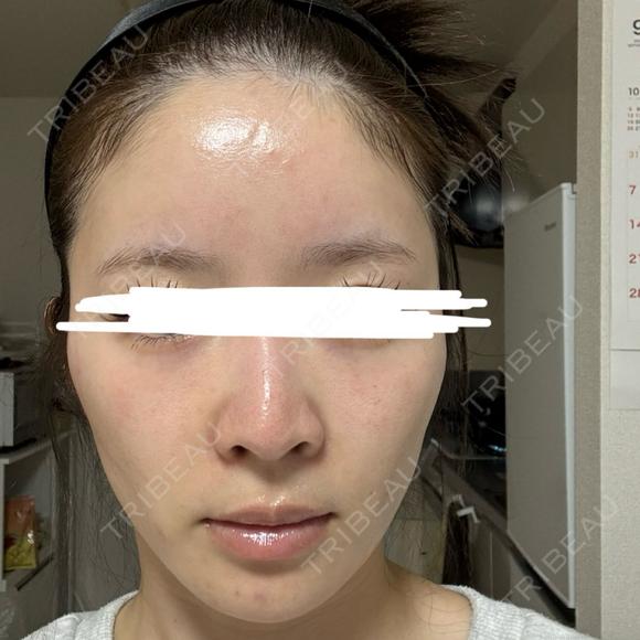 ボトックス（眉間） / ボトックス（額） / ヒアルロン酸注入（鼻翼基部） FIG CLINIC AFTER メイン用